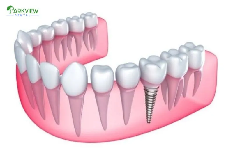 Ưu điểm của trồng răng Implant