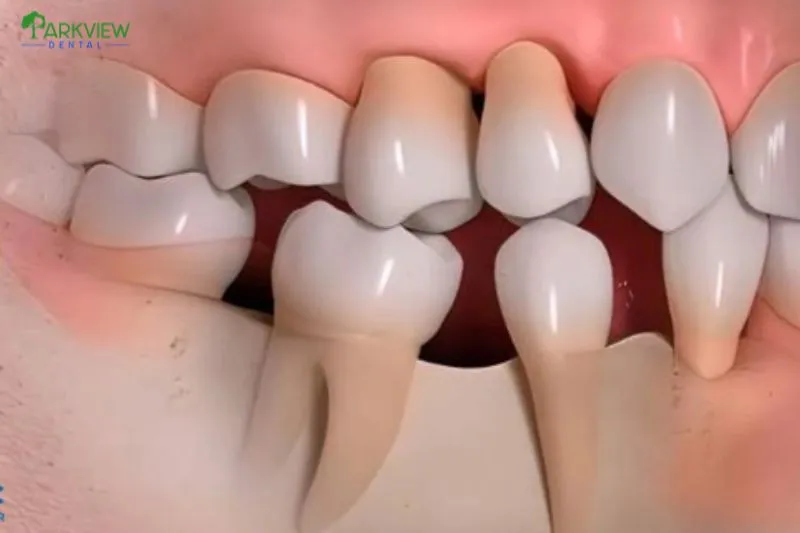 Viêm tủy răng sau khi bọc sứ có nguy hiểm không?