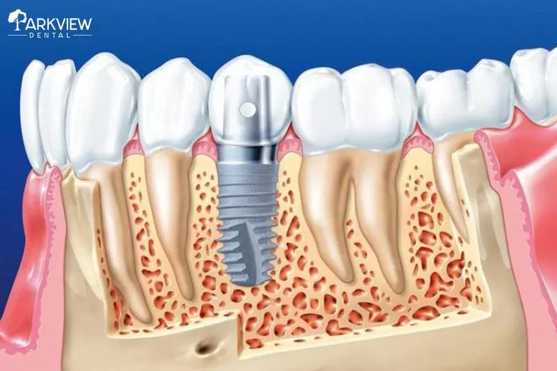 Yếu tố ảnh hưởng đến bảng giá trồng răng Implant
