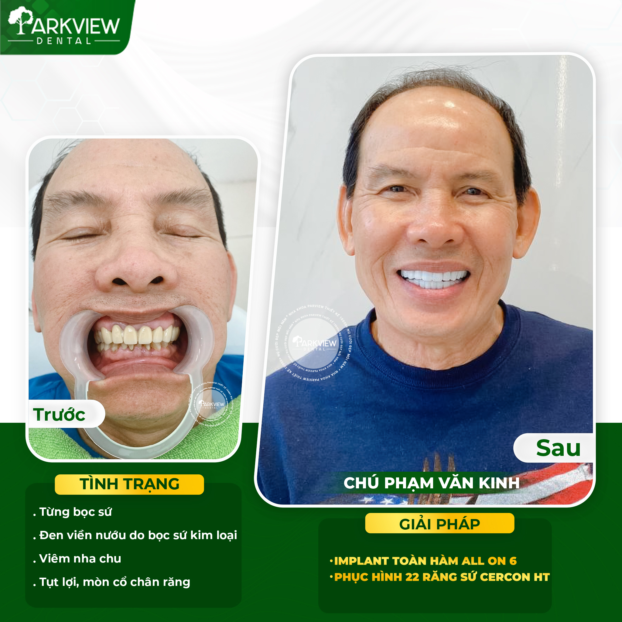 Khôi phục chức năng ăn nhai trọn vẹn nhờ phương pháp Implant