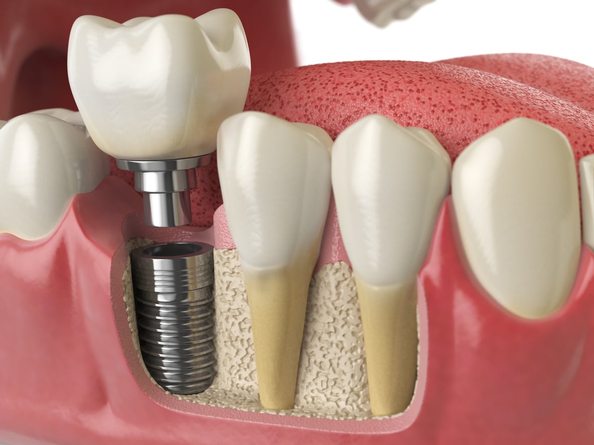 Hình ảnh minh hoạ phương pháp trồng răng Implant